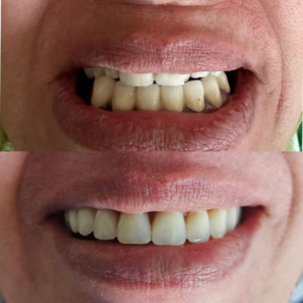 dentiste rabtat- teeth-after