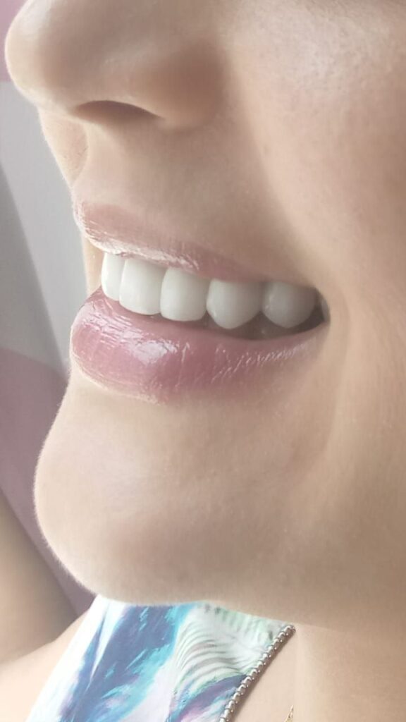 dentiste rabtat- teeth-after