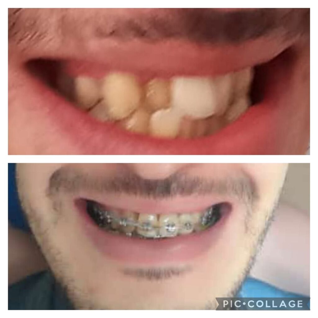 dentiste rabtat- teeth-after