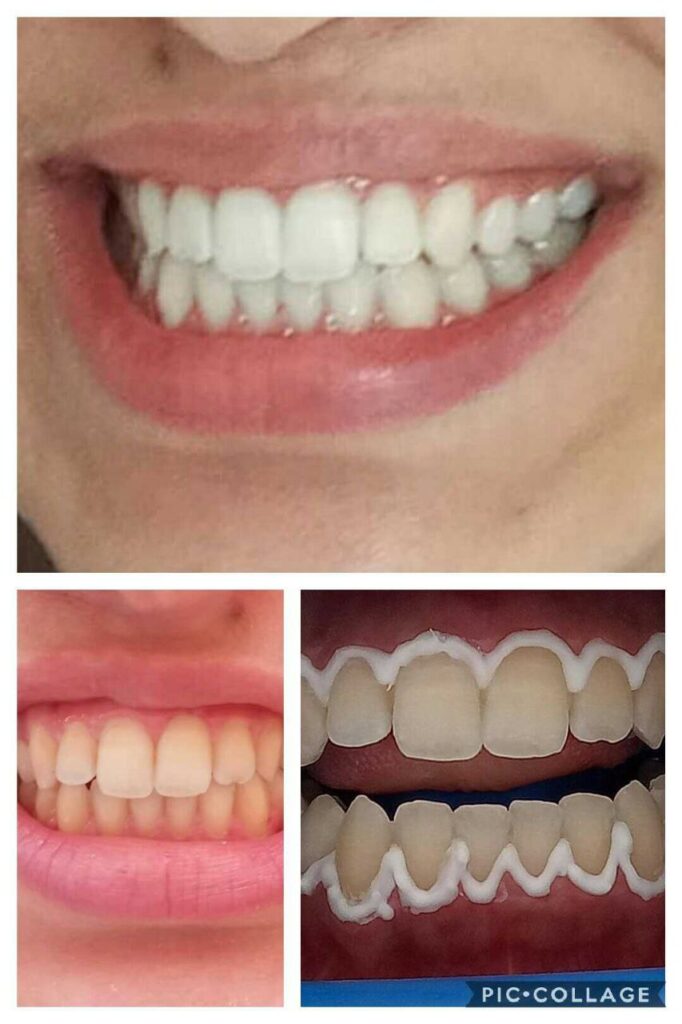 dentiste rabtat- teeth-after